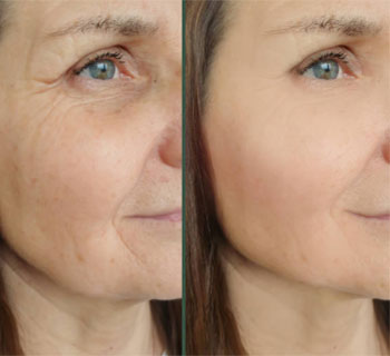 Side of face before and after