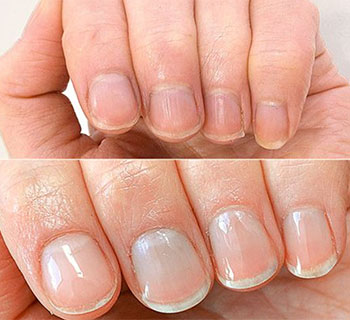Fingernail before and after
